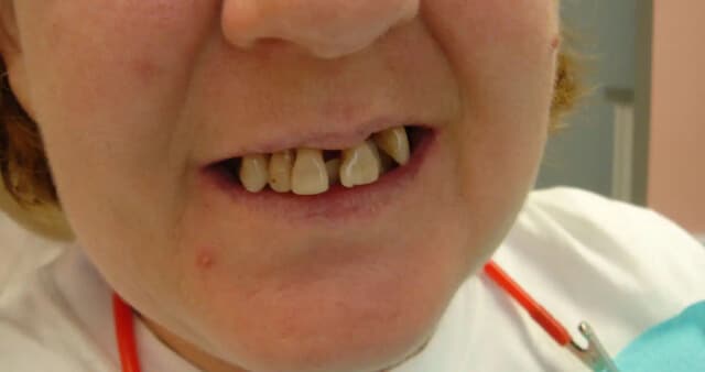 Before treatment Image - Dover Family Dentistry - Dentist in Mountain Home AR
