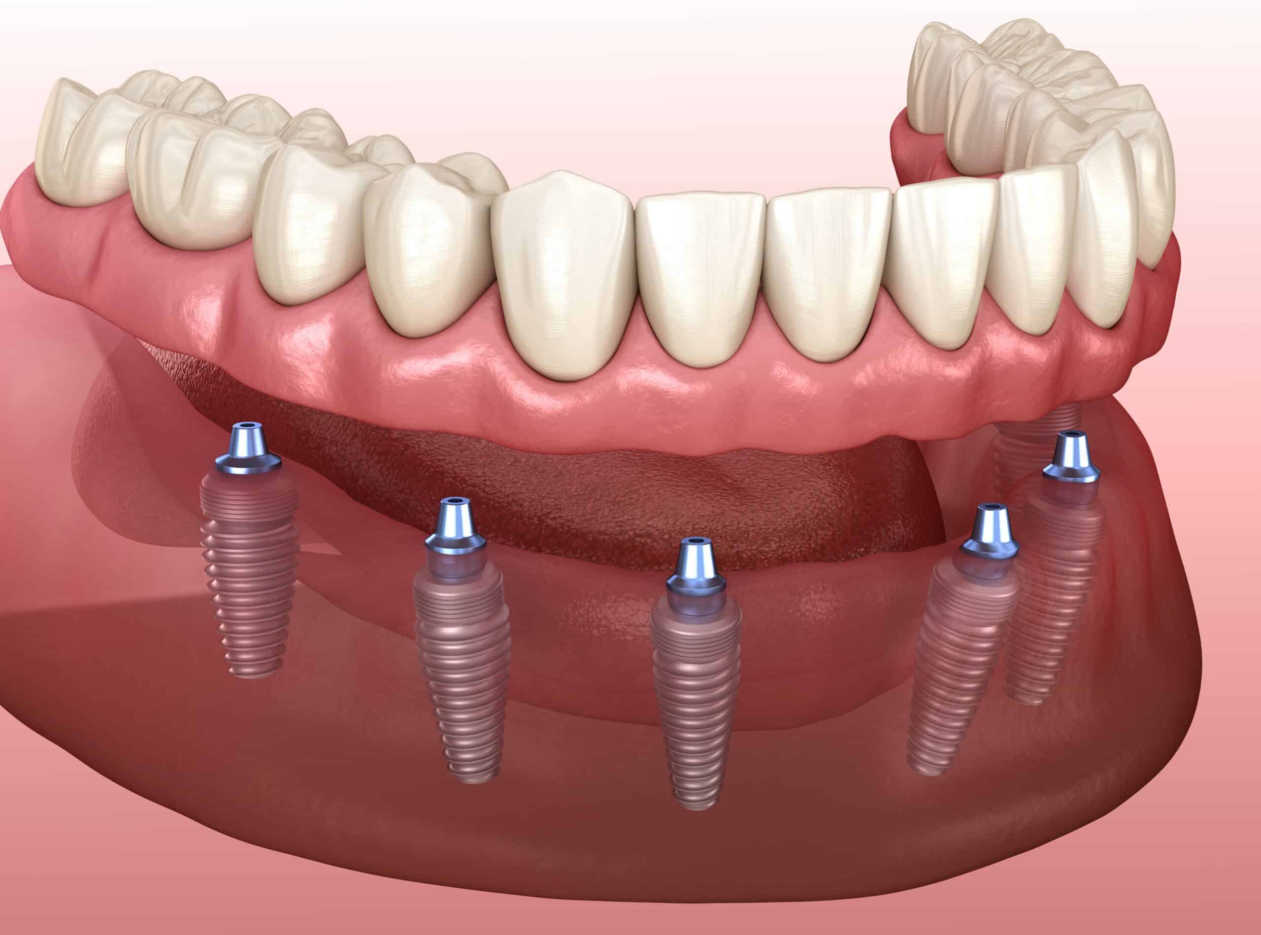 full-arch dental implants