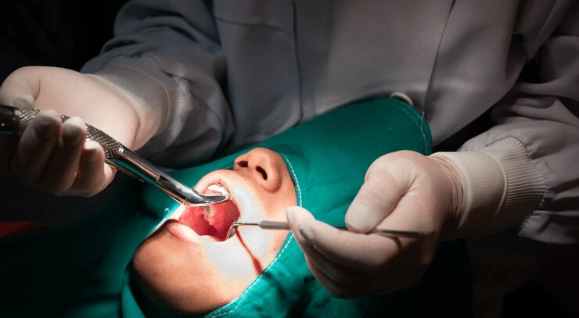 Stop The Bleeding After An Oral Surgery